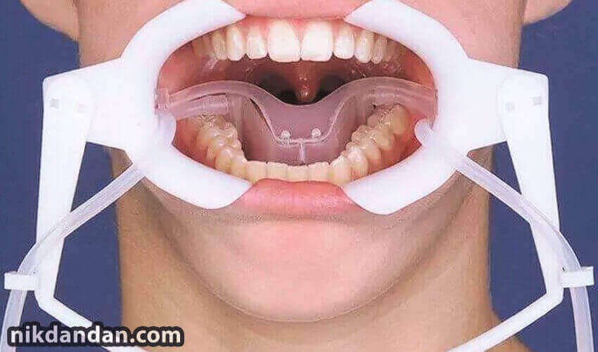 Dental mouth opener