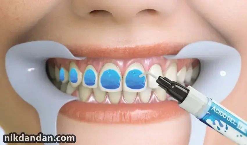 Tooth etching acid