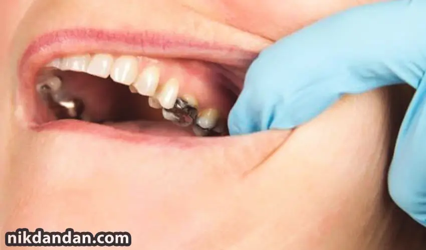 dental amalgam