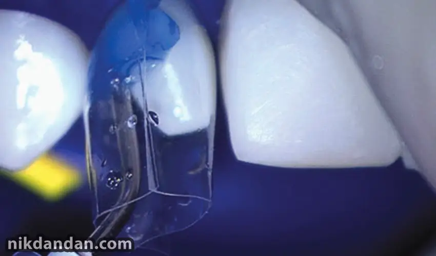 Advantages of dental composite