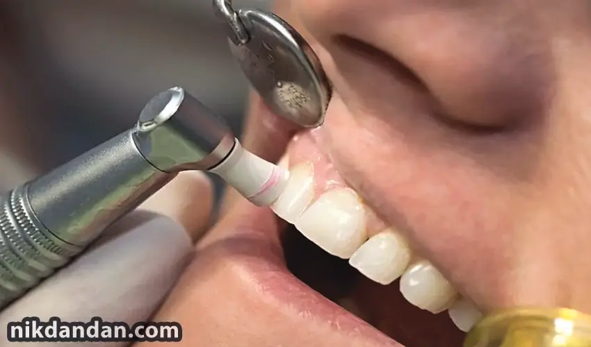 Application of dental composite