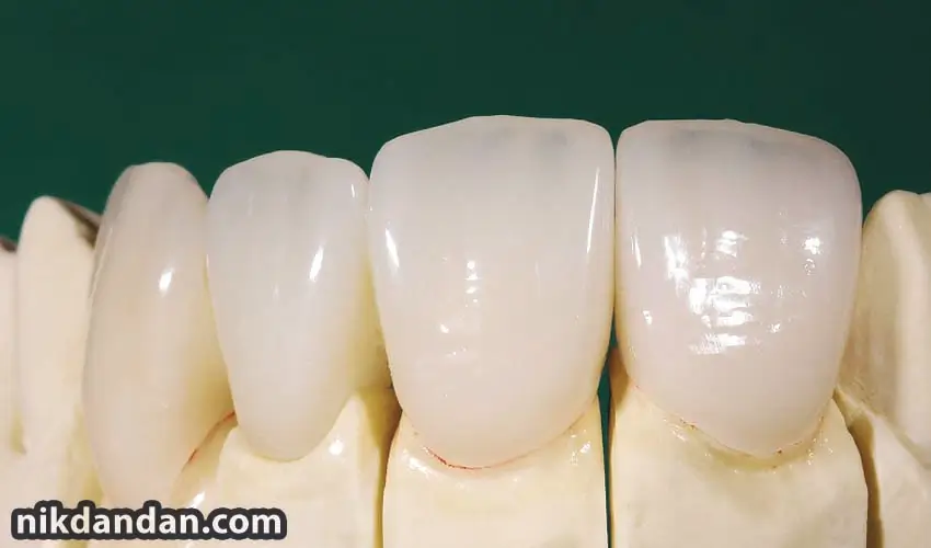 Buying dental composite