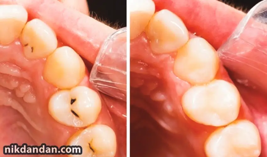 Dental composite techniques