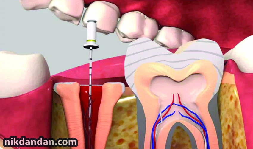 Root canal treatment