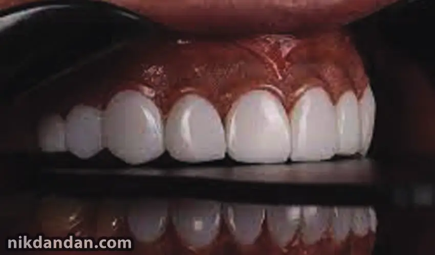 Tips for composite teeth