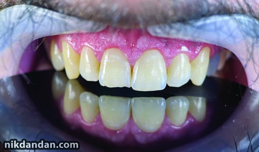 Buying composite teeth