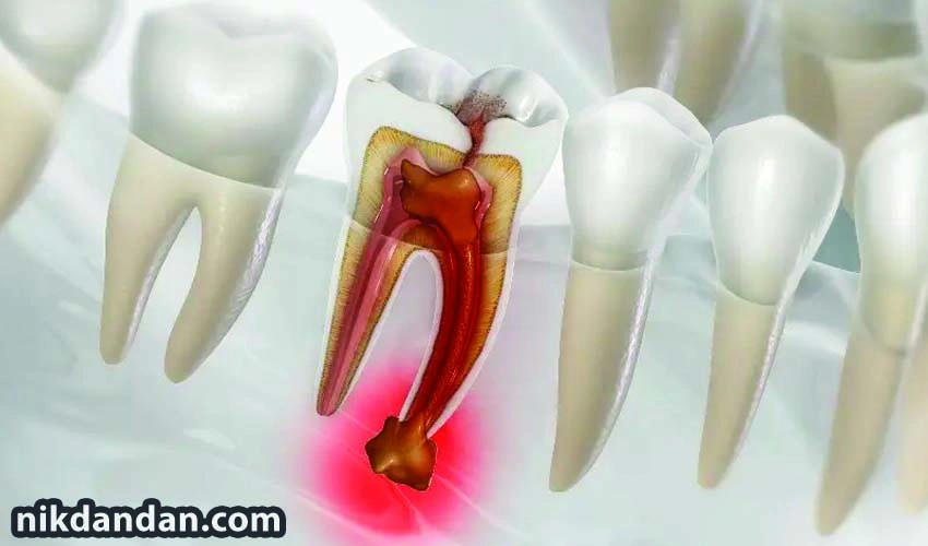 Dental gutta percha